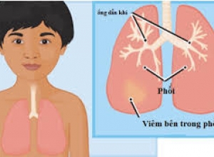 Cách điều trị và chăm sóc trẻ nhỏ bị viêm phổi đúng cách